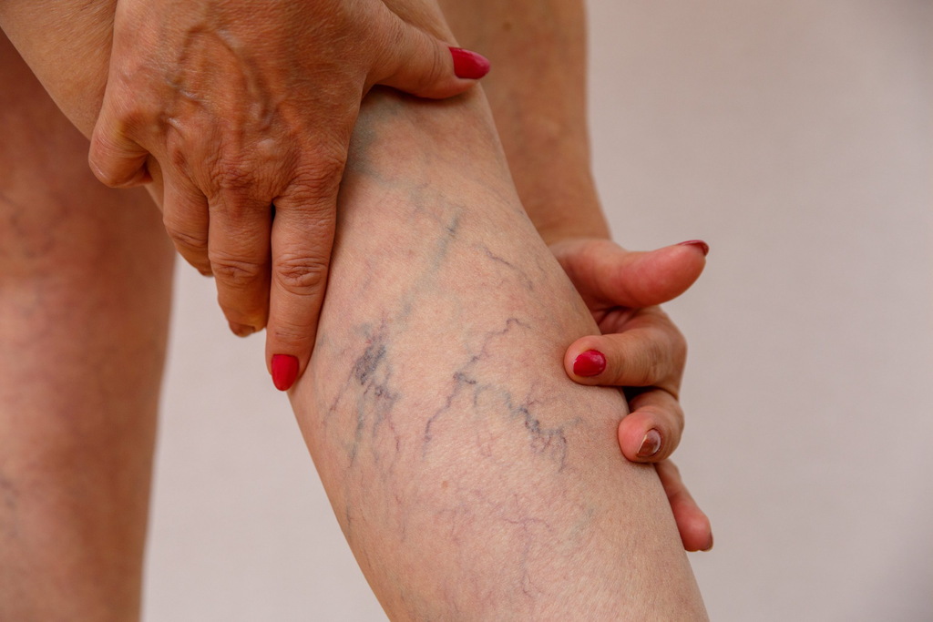 Cuidados con las Varices y Molestias en las Piernas